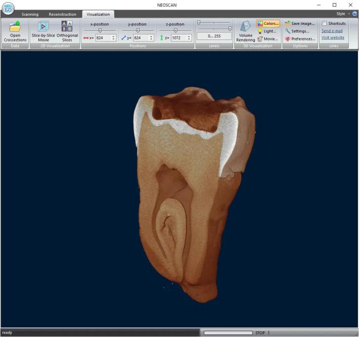 Un dente molare scansionato a una dimensione di pixel di 9,8 um, che mostra crepe nella dentina e nello smalto con materiale di limatura corroso.
