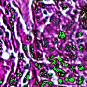 Spectral Mapping in Green of Unique Cancerous Elements in the Tissue