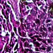 H&E Stained Squamous Cell Carcinoma Tissue
